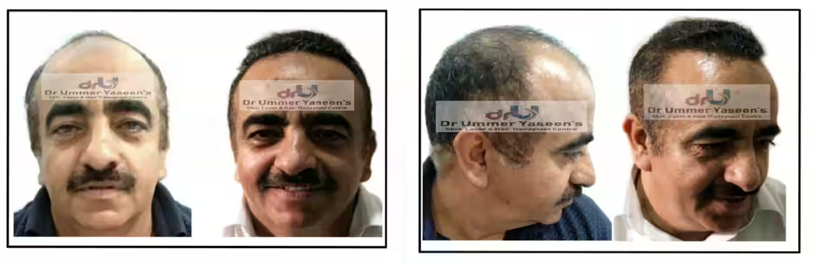Bio Stimulated FUE